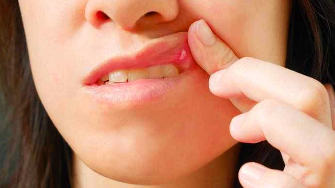 Dudakta uçuk neden çıkar, nasıl geçer? Stresten dudak uçuklaması hangi hastalığın belirtisidir?