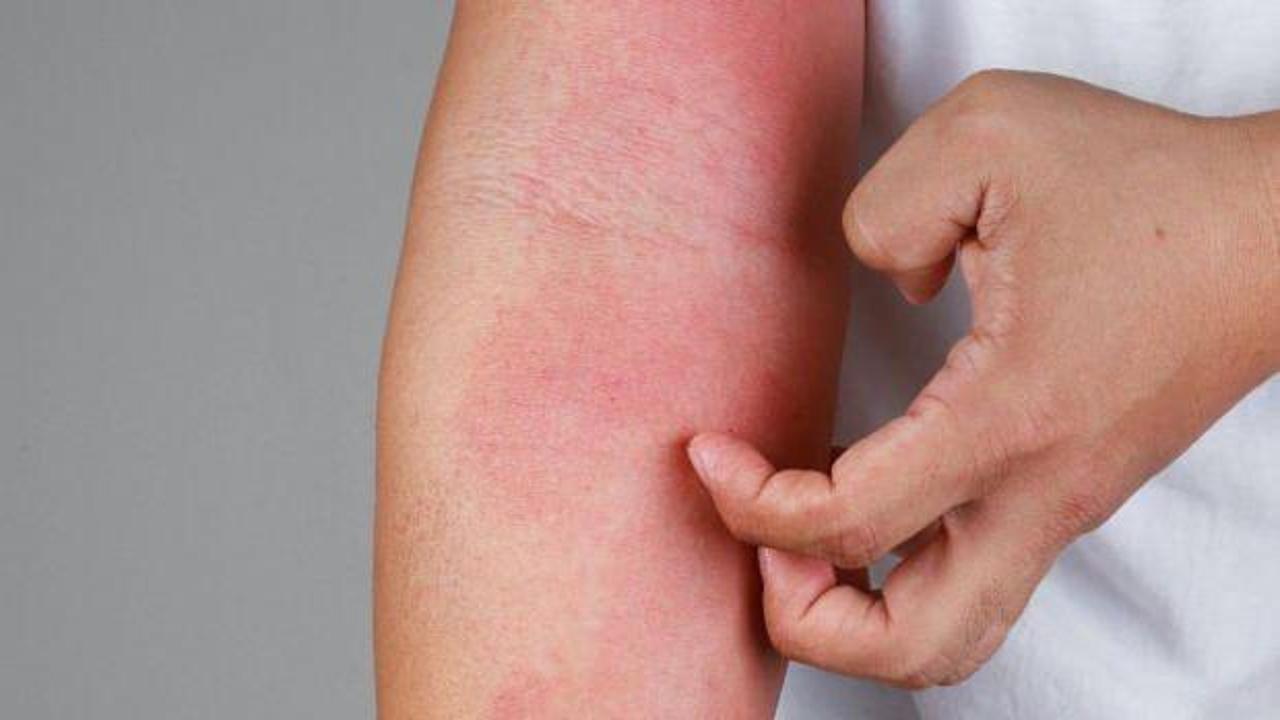 Uyuz vakalarında büyük artış! Bazı kremler artık çare olmuyor