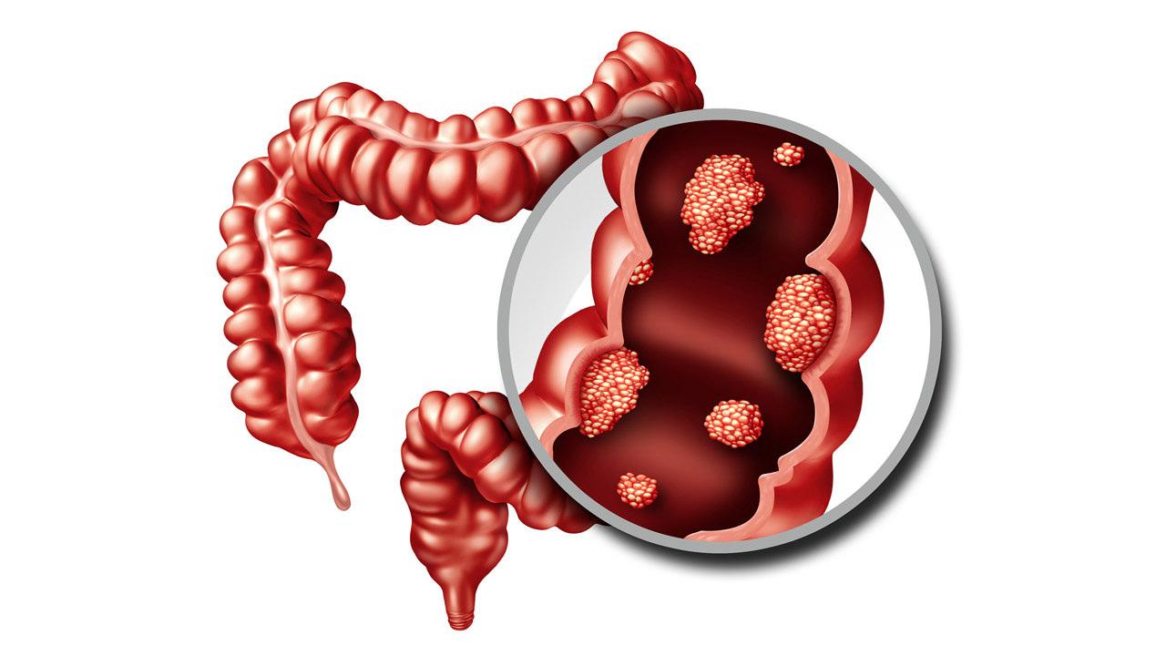 Kolon kanseri nedir, belirtileri nelerdir? Kolon kanseri kurtulma şansı var mı?