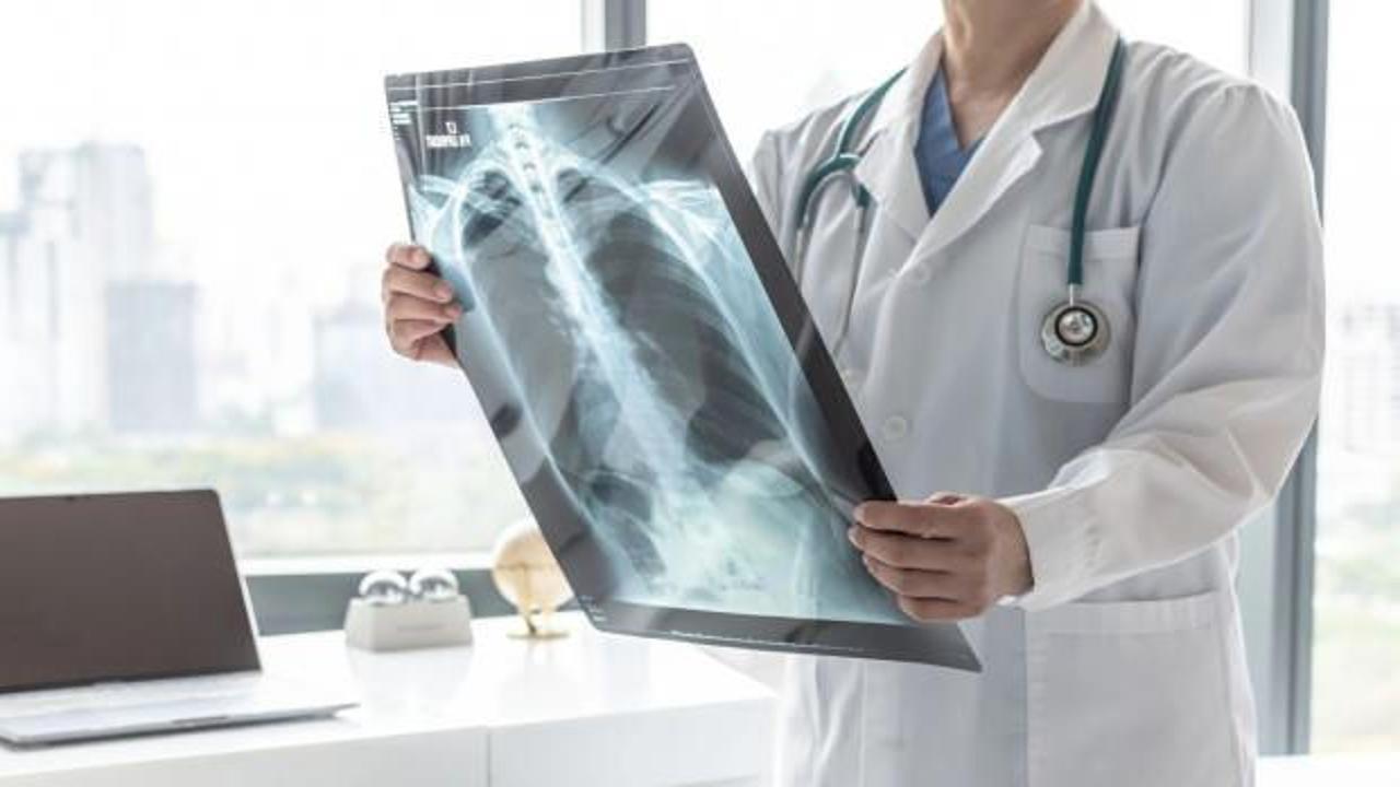 Dünyada en çok ölüme neden olan kanser: Akciğer kanseri