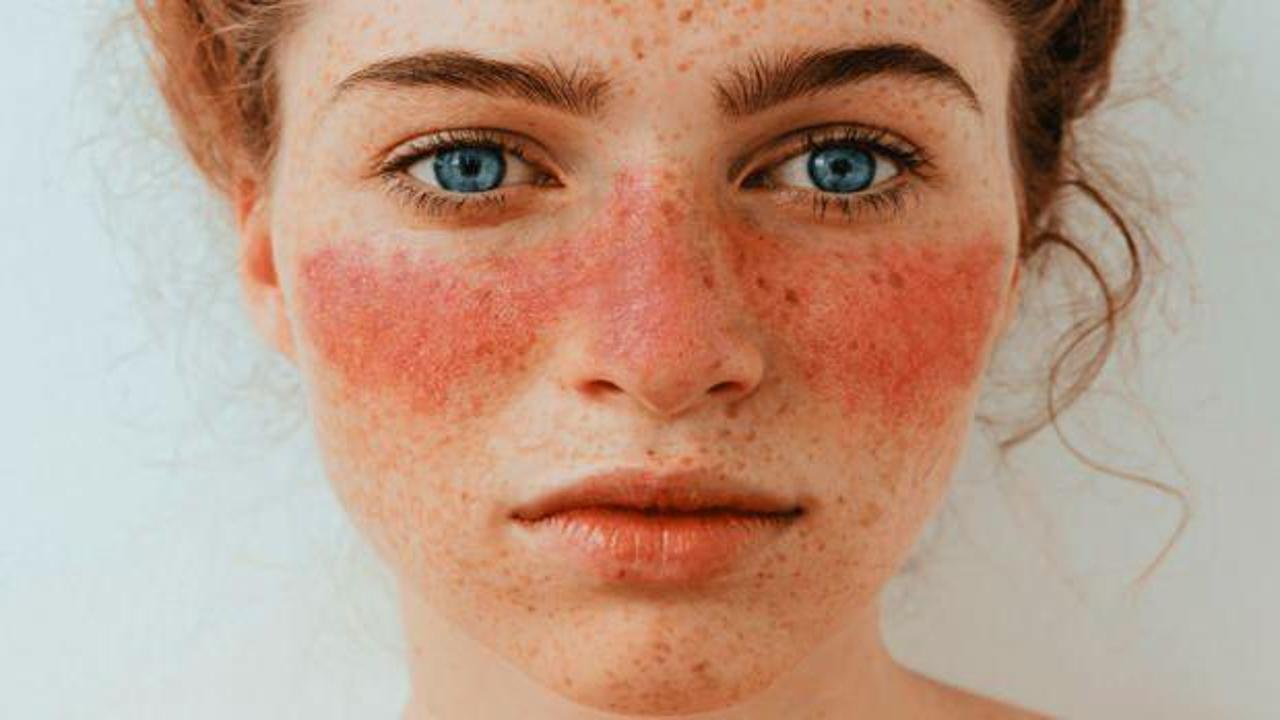 Lupus hastalığı nedir, belirtileri nelerdir? Lupus hastalığı öldürücü müdür, tedavisi nedir?