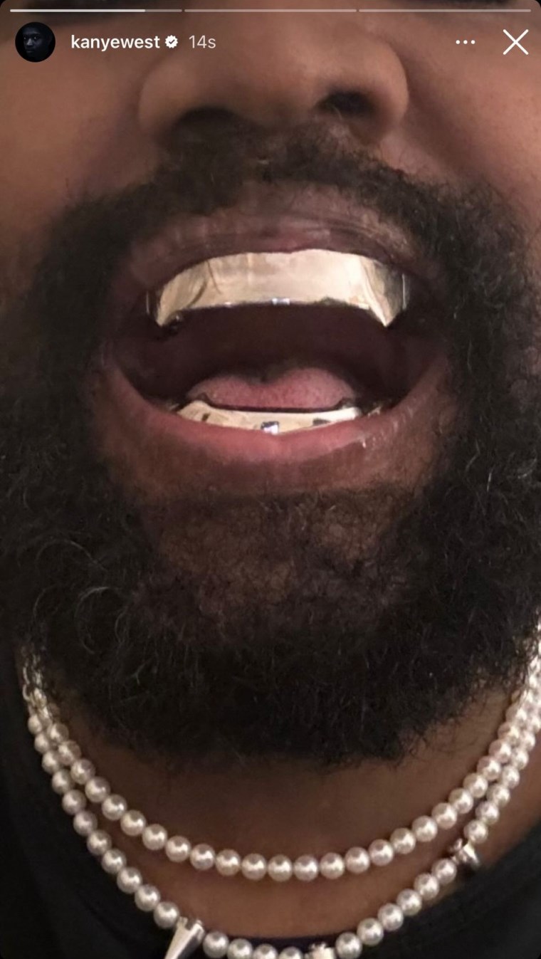 Kanye West tüm dişlerini söktürdü, yerine 'elmastan daha pahalı' protez taktırdı!