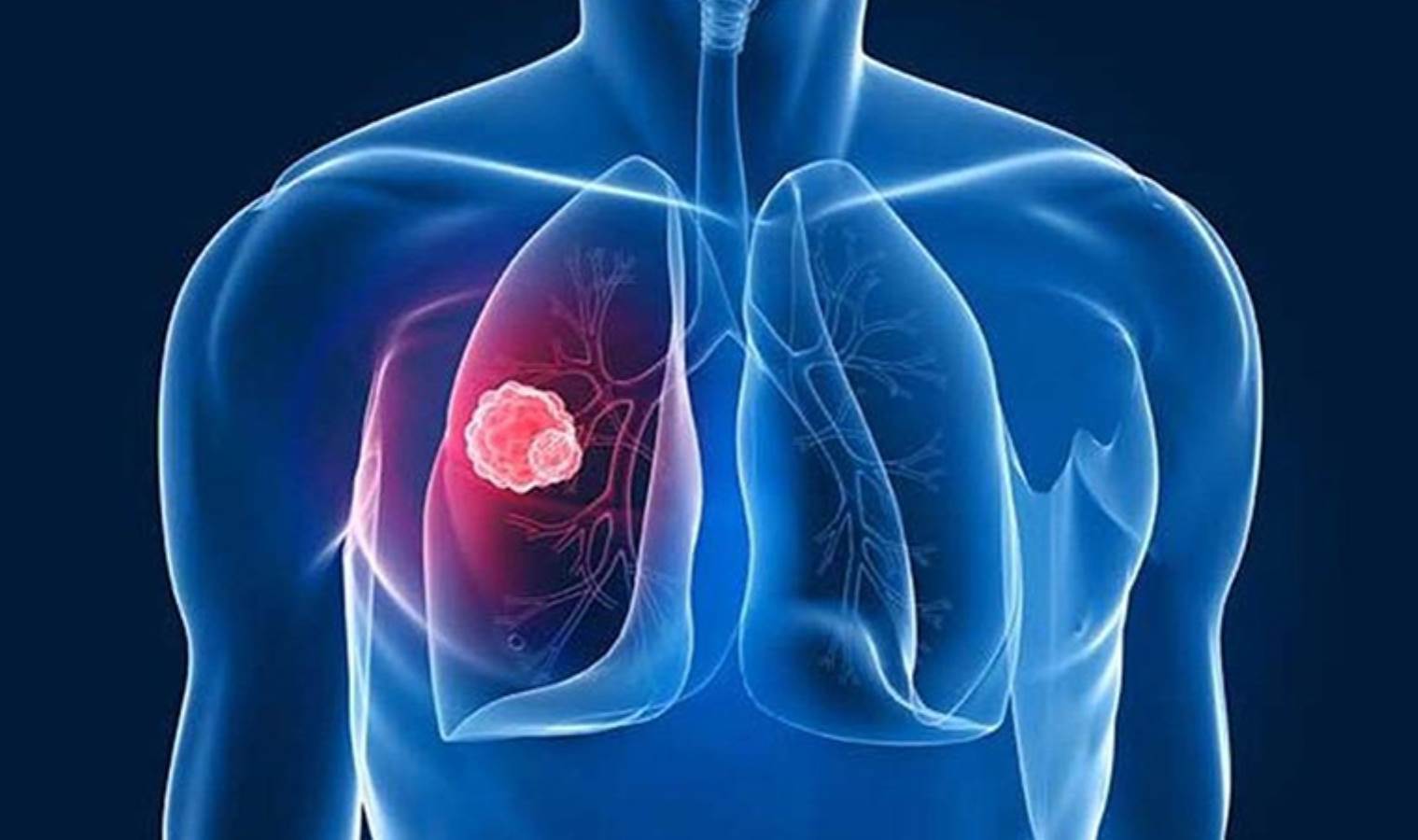 Uzmanından uyarı geldi: Verem ve akciğer kanseri oluyorsunuz