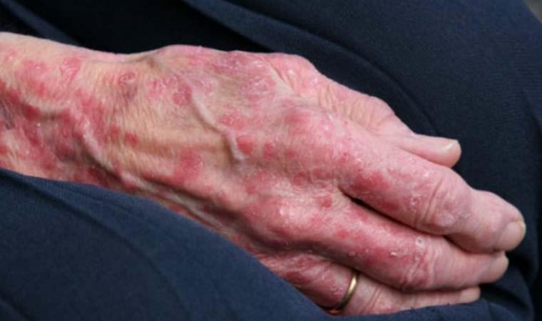 Cüzzam hastalığında erken tanı önemli: ‘Tedavi edilmediği takdirde sakatlığa yol açıyor’