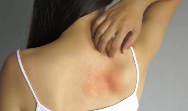 Uyuzla karıştırılıyor! Histamin İntoleransı nedir? Histamin İntoleransının sebepleri nelerdir?