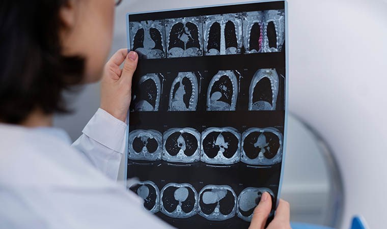 Uzmanından uyarı: ‘Kan sulandırıcı kullanımı beyin kanaması riskini artırabilir’