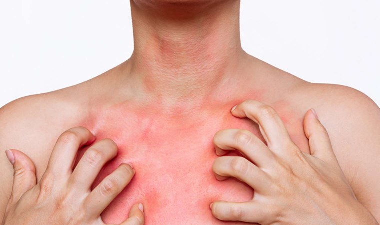 Dermatoloji uzmanları açıkladı: ‘Uyuz hastalığının tedavisi kolaylaştı’