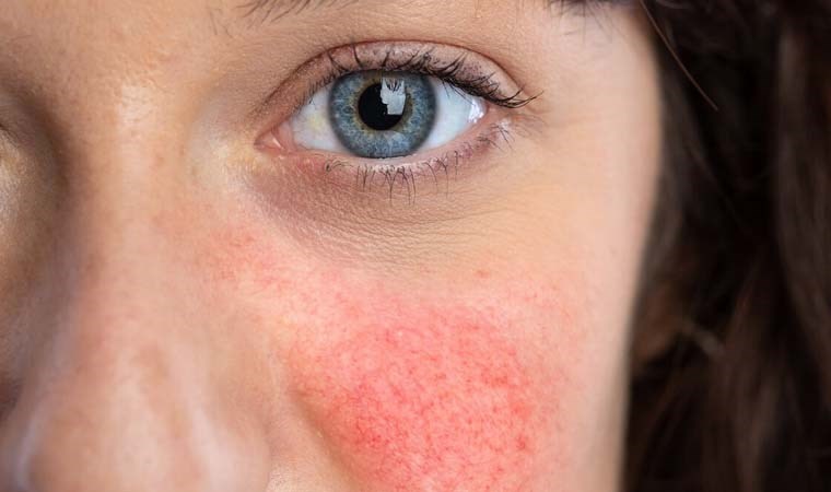 Gül hastalığı (Rozasea) nedir? Gül hastalığı (Rozasea) belirtileri neler?