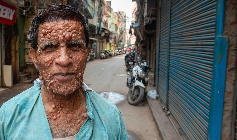 Çoğunun adını hiç duymadınız! Türkiye’de ABD ve Avrupa’dan daha fazla görülüyor