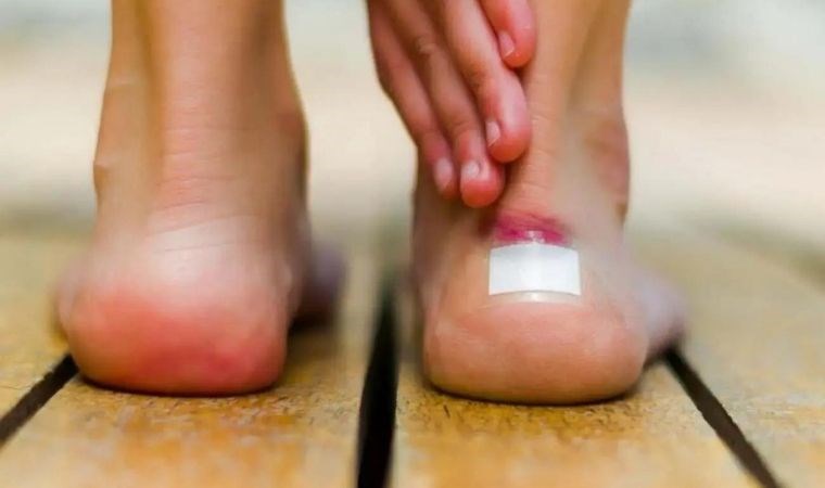 Ayakkabı vurduğunda oluşan yaralara 5 etkili çözüm: Birkaç kullanımda yaralarını hızlıca iyileştiriyor... - Son Dakika Yaşam Haberleri | Cumhuriyet