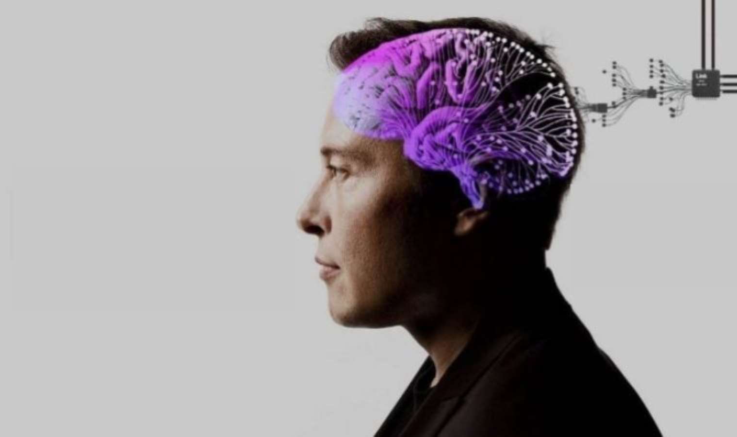 Stentrode, Musk'ın Neuralink'inden çok daha ileride olabilir