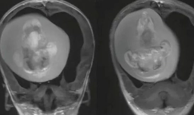 Doktorlar şaşkına döndü: Bebeğin beyninden ikizi çıkarıldı