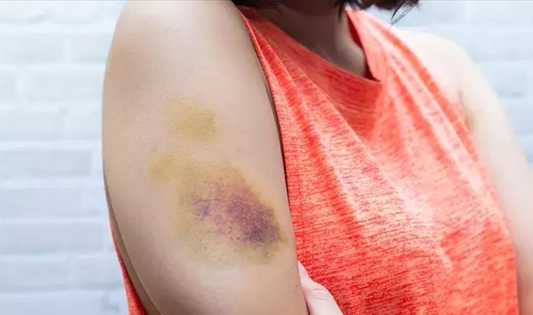 Bu belirtiler hemofili habercisi olabilir