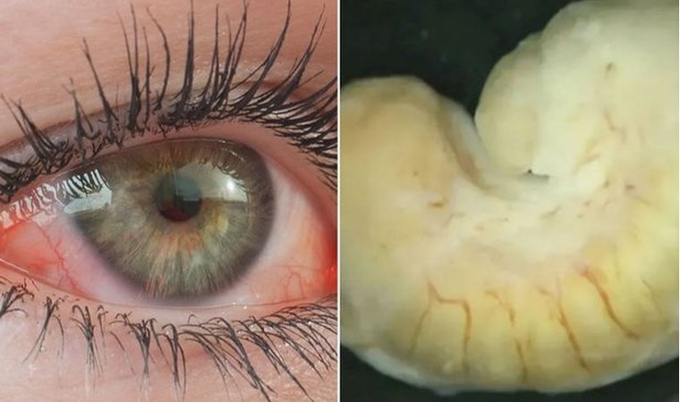 Gözünün içinde tespit edildi: Doktorlar dehşete düştü!