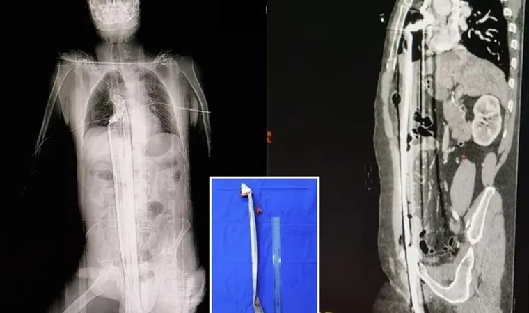 Ölümden ‘mucize’ kurtuluşu doktorları şaşırttı: 91 cm uzunluğunda demir çubuk çıkarıldı