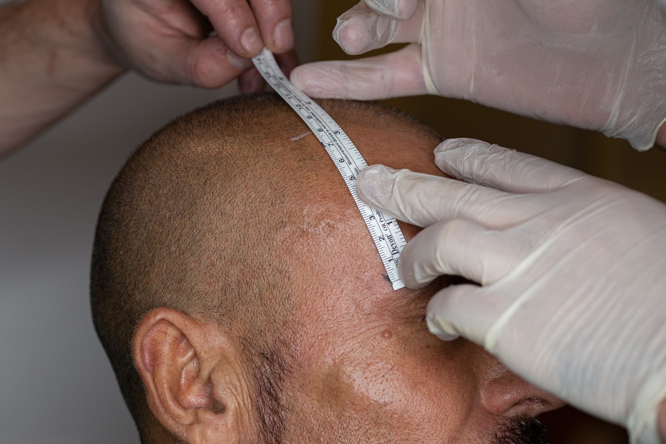 Clinista Saç Ekim Merkezi’nin Başarı Hikayelerine Katılın