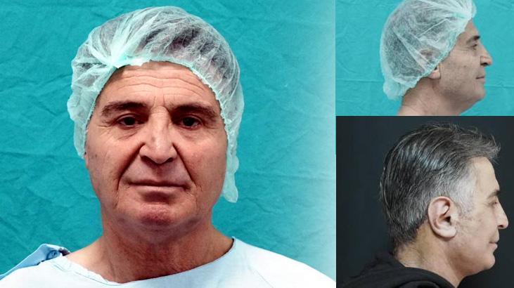 Bitlis Devlet Hastanesi’nde Estetik Cerrahide Önemli Adım